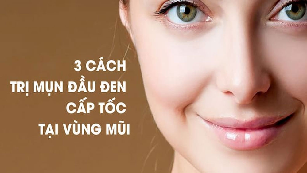 3 cách trị mụn đầu đen cực đơn giản tại nhà